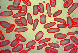 Red-blood-cells-elliptocytosis 370 60.jpg