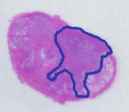 The tumor contour traced with a pen