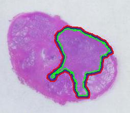 The tumor captured by Pixcavator - inside contour